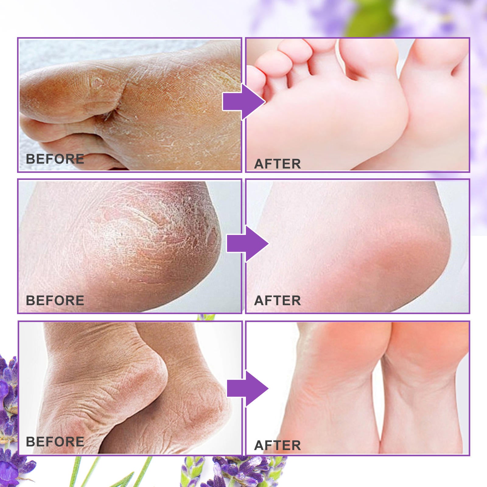 Aliver Foot Peeling Moisturizing Natural Exfoliating Foot Mask